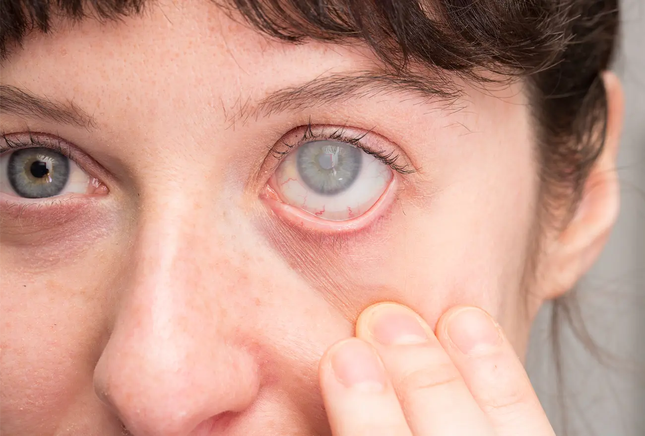 SLT Laser Treatment for Glaucoma