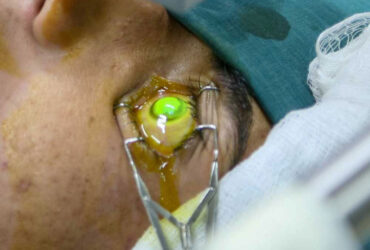 Korneal-Cross-Linking