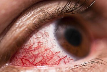 uveitis-scaled uveitis-scaled